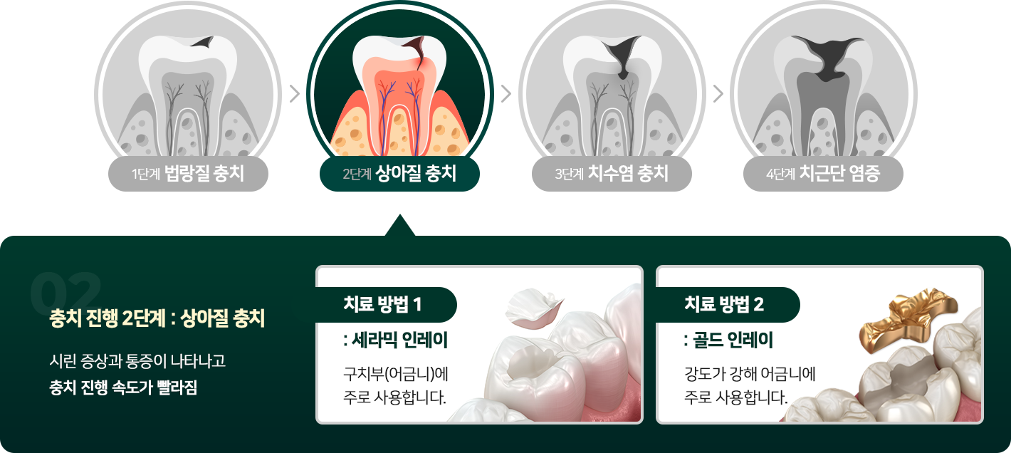 상아질 충치