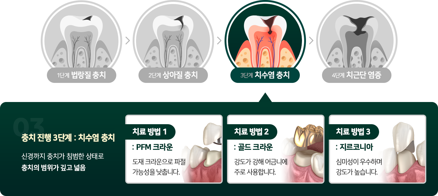 치수염 충치