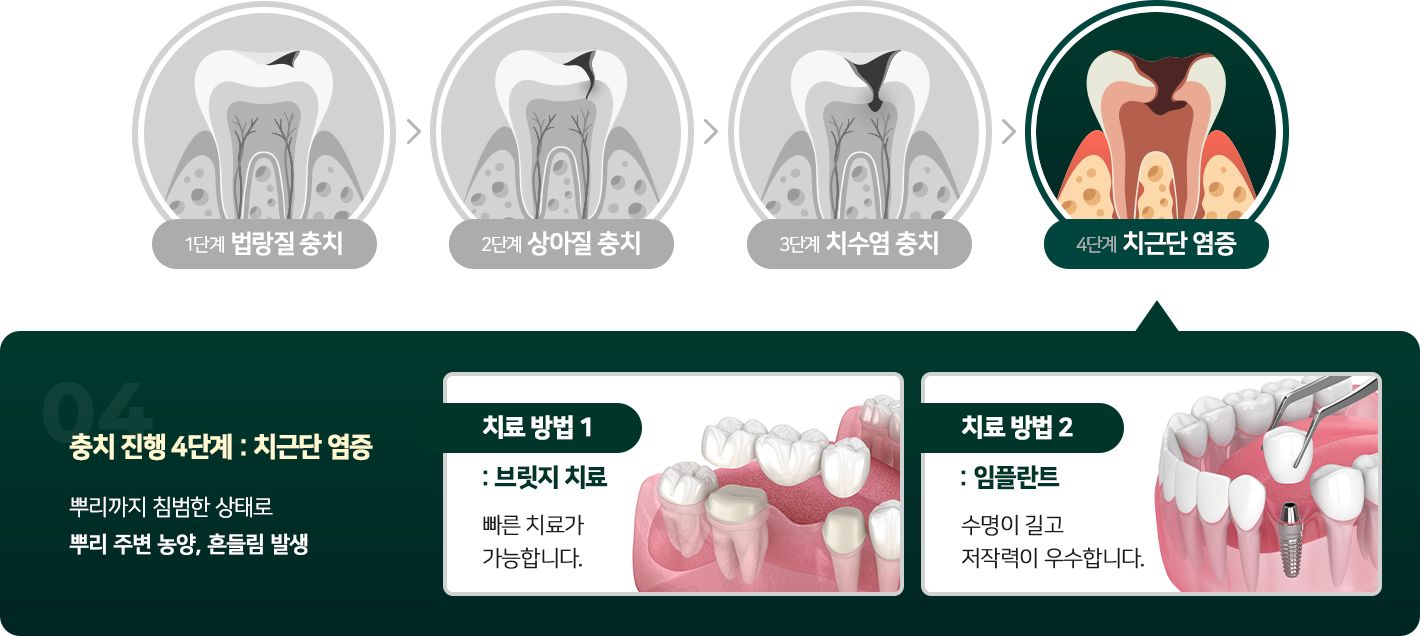 치근단 충치