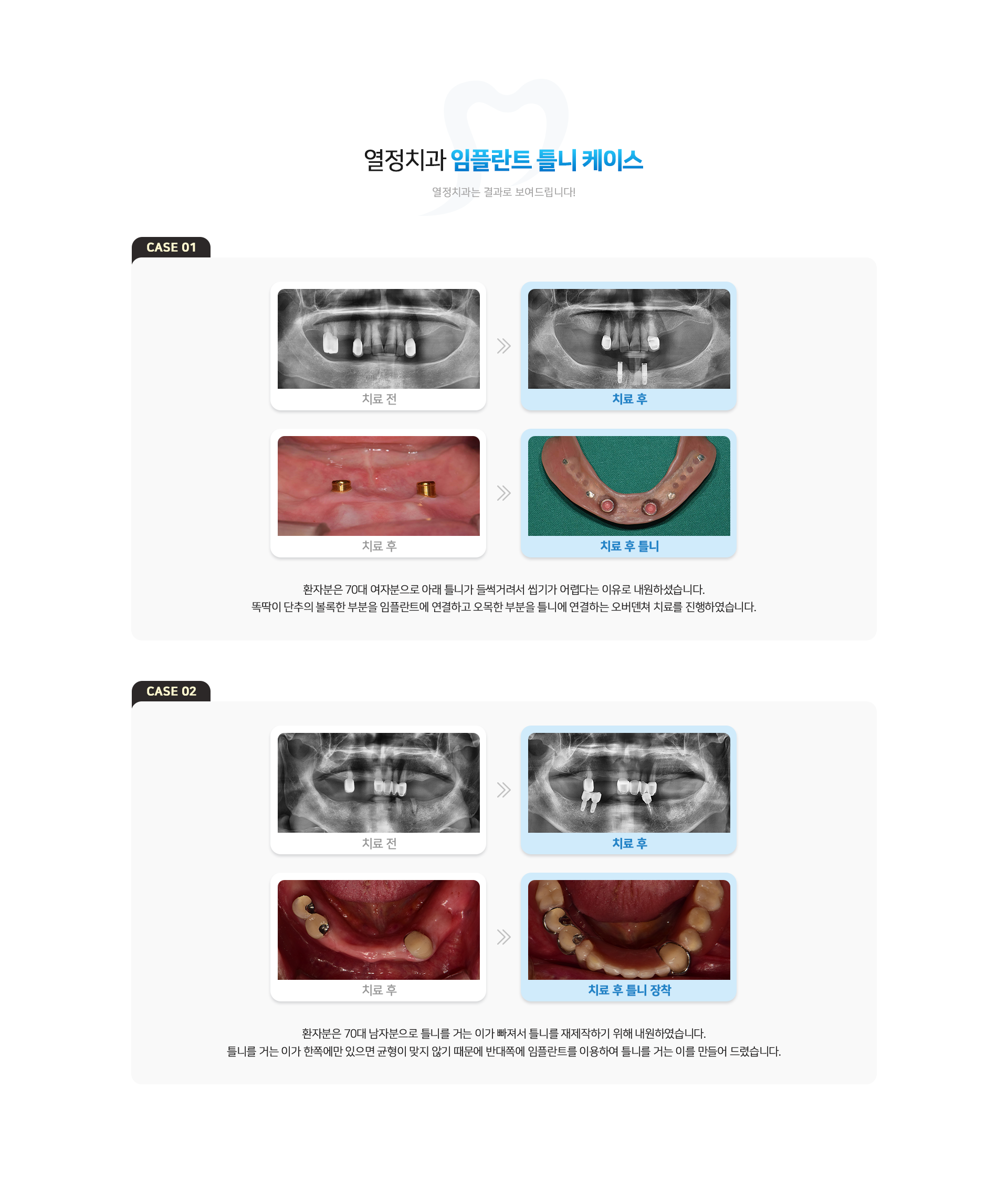 열정치과 임플란트 틀니 케이스