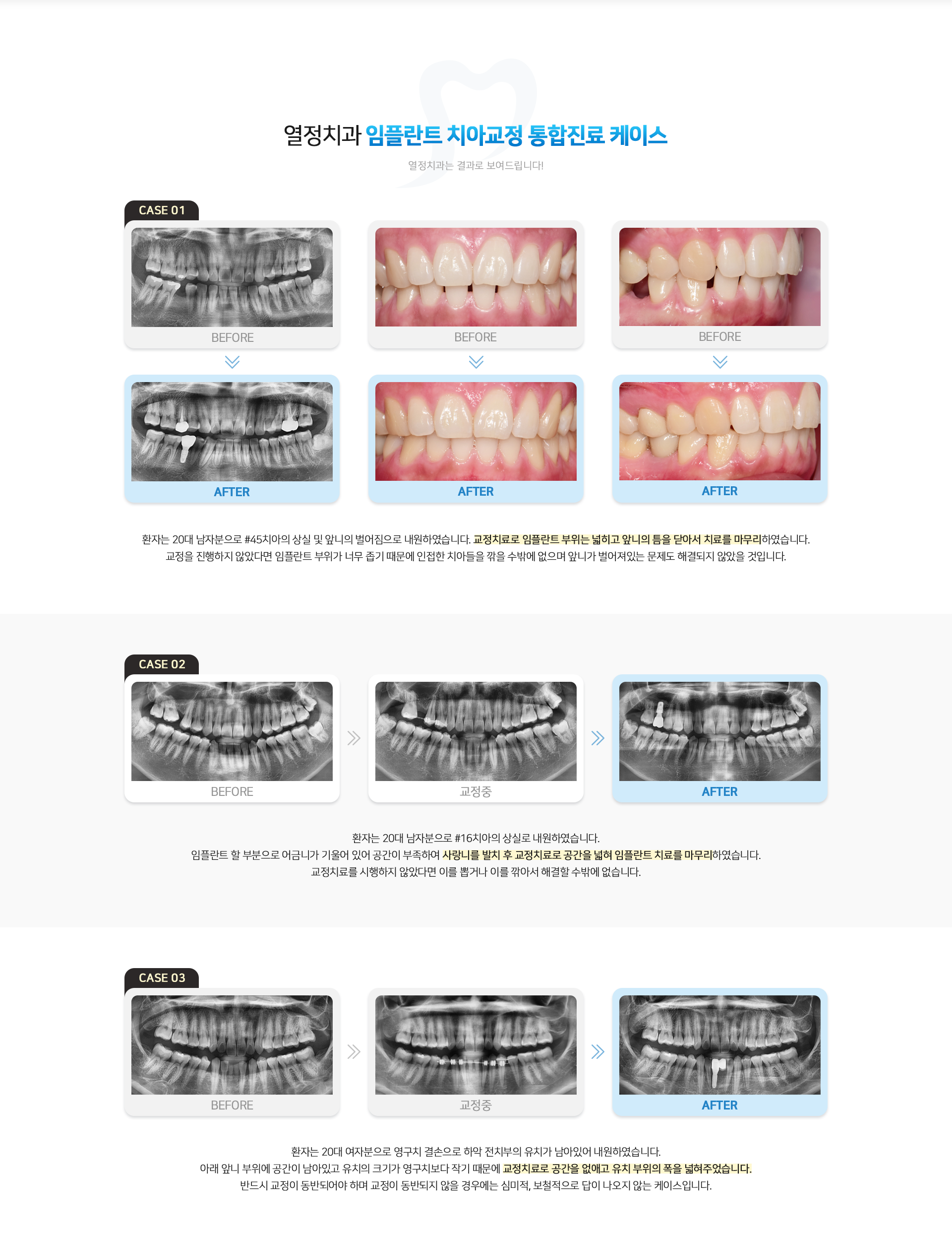 열정치과 임플란트 치아교정 통합진료 케이스