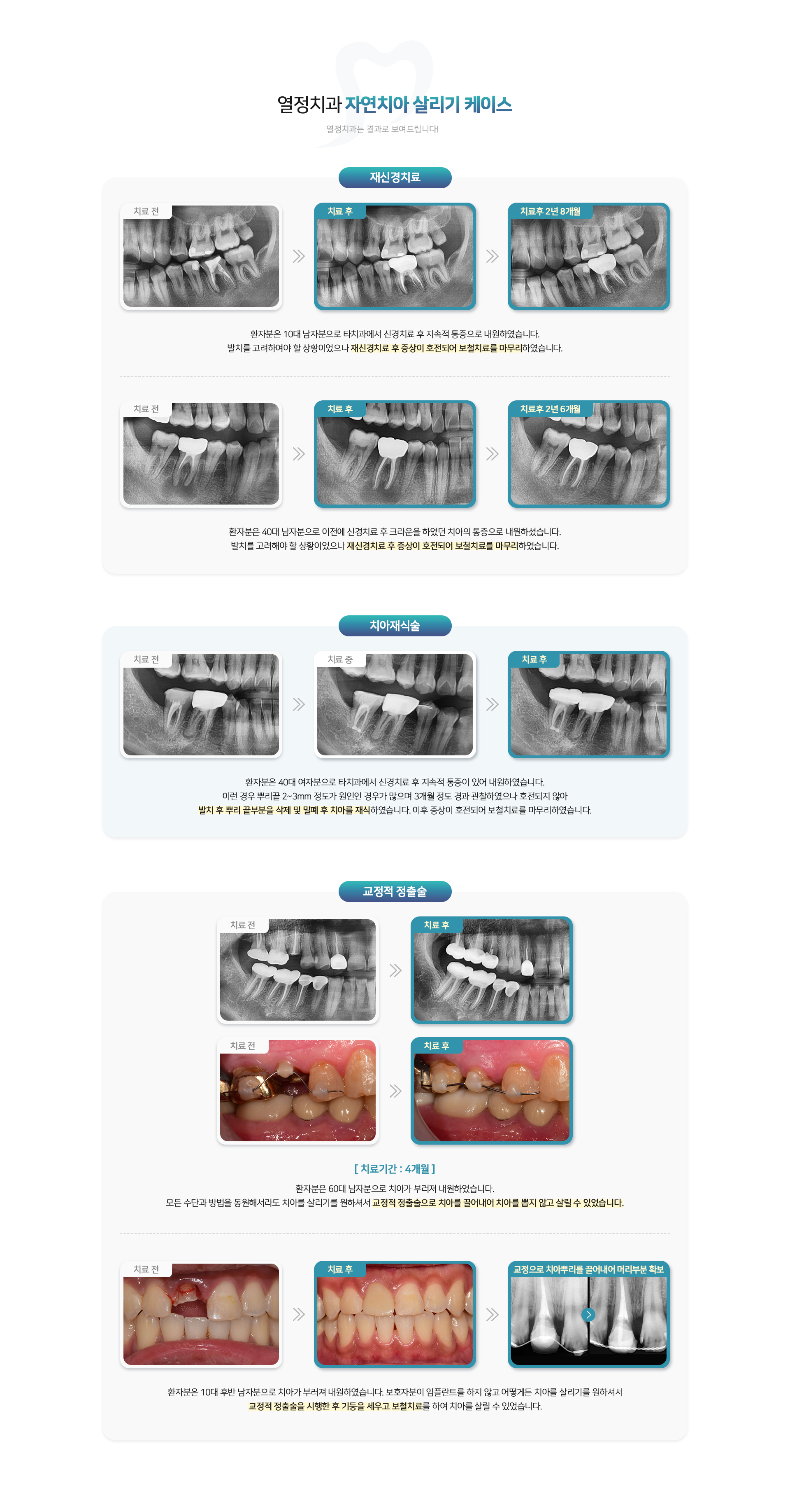 열정치과 자연치아 살리기 케이스 - 열정치과는 결과로 보여드립니다!